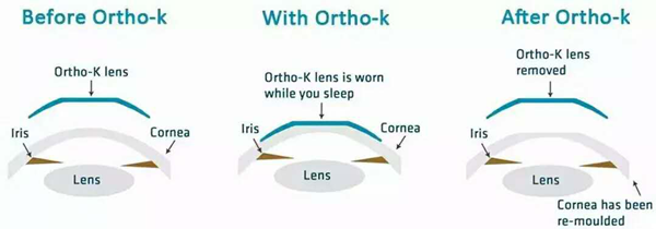 小兒眼病,希瑪瑞視眼科,上海眼科醫(yī)院