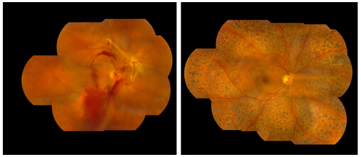 青光眼,希瑪瑞視眼科,上海眼科醫(yī)院