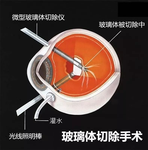 玻璃體視網(wǎng)膜,希瑪瑞視眼科,上海眼科醫(yī)院