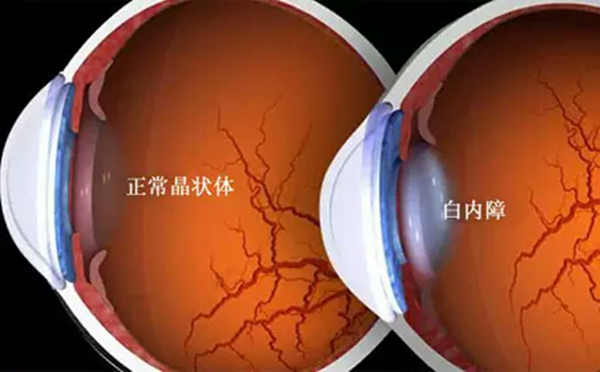 白內障,希瑪瑞視眼科,上海眼科醫院