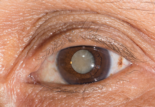 白內(nèi)障,?，斎鹨曆劭?上海眼科醫(yī)院