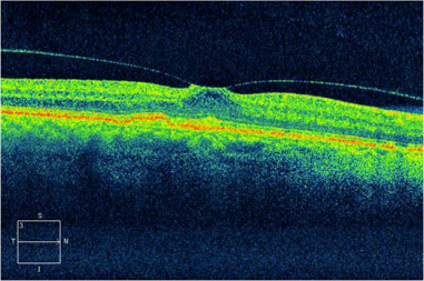 玻璃體視網膜,希瑪瑞視眼科,上海眼科醫院 玻璃體視網膜,希瑪瑞視眼科,上海眼科醫院