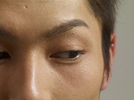 小兒眼病,希瑪瑞視眼科,上海眼科醫院