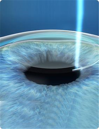 屈光矯視,希瑪瑞視眼科,上海眼科醫院 屈光矯視,希瑪瑞視眼科,上海眼科醫院