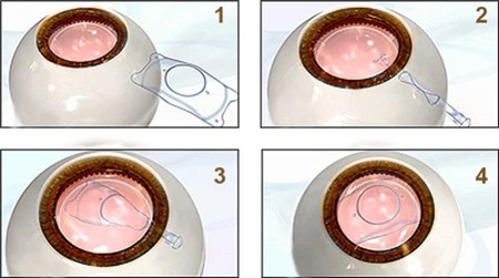 屈光矯視,希瑪瑞視眼科,上海眼科醫院 屈光矯視,希瑪瑞視眼科,上海眼科醫院