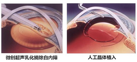 白內障,?，斎鹨曆劭?上海眼科醫院