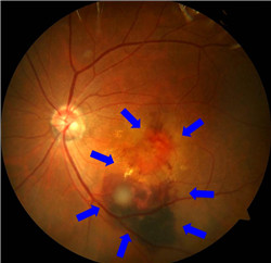 玻璃體視網(wǎng)膜,希瑪瑞視眼科,上海眼科醫(yī)院 玻璃體視網(wǎng)膜,希瑪瑞視眼科,上海眼科醫(yī)院