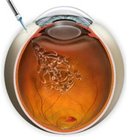 玻璃體視網(wǎng)膜,希瑪瑞視眼科,上海眼科醫(yī)院 玻璃體視網(wǎng)膜,希瑪瑞視眼科,上海眼科醫(yī)院