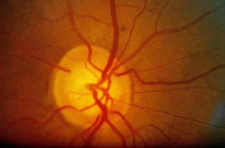 青光眼,希瑪瑞視眼科,上海眼科醫院 青光眼,希瑪瑞視眼科,上海眼科醫院