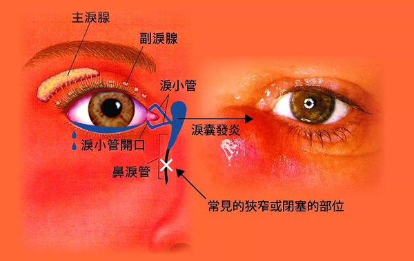 眼眶病,希瑪瑞視眼科,上海眼科醫院