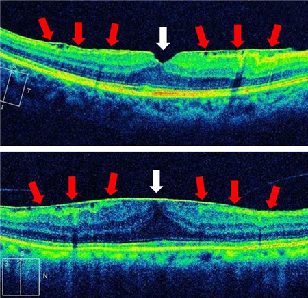 玻璃體視網膜,?，斎鹨曆劭?上海眼科醫院