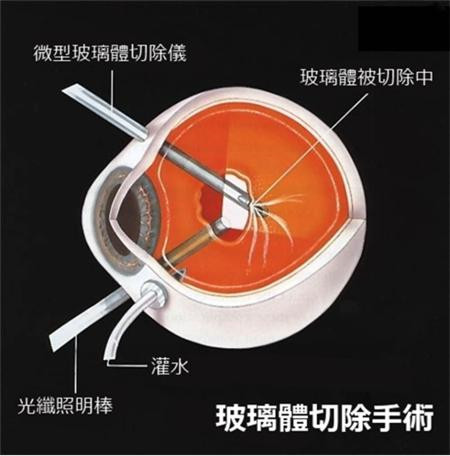 玻璃體視網膜,?，斎鹨曆劭?上海眼科醫院