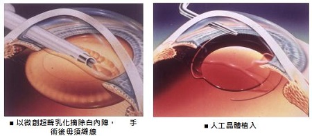 白內(nèi)障,?，斎鹨曆劭?上海眼科醫(yī)院