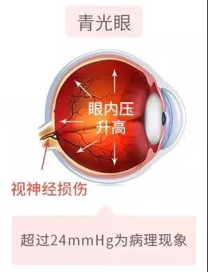 青光眼,希瑪瑞視眼科,上海眼科醫(yī)院