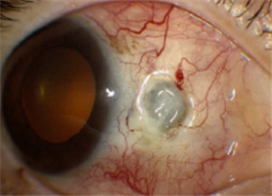 眼表眼角膜,希瑪瑞視眼科,上海眼科醫院