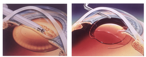 青光眼,希瑪瑞視眼科,上海眼科醫(yī)院 青光眼,希瑪瑞視眼科,上海眼科醫(yī)院