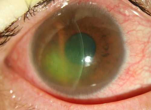 眼表眼角膜,?，斎鹨曆劭?上海眼科醫院