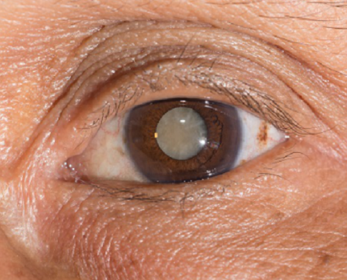 眼表眼角膜,希瑪瑞視眼科,上海眼科醫院