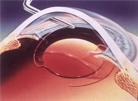 青光眼,希瑪瑞視眼科,上海眼科醫院