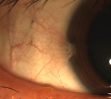 眼表眼角膜,?，斎鹨曆劭?上海眼科醫院