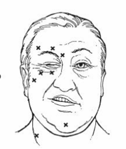 眼眶病,希瑪瑞視眼科,上海眼科醫(yī)院