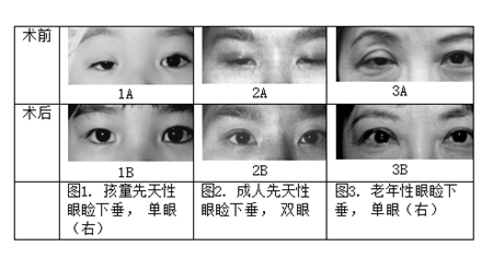 眼眶病,希瑪瑞視眼科,上海眼科醫(yī)院