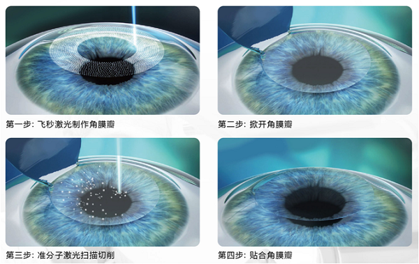 屈光矯視,希瑪瑞視眼科,上海眼科醫(yī)院 屈光矯視,希瑪瑞視眼科,上海眼科醫(yī)院