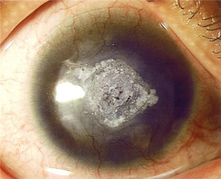 眼表眼角膜,?，斎鹨曆劭?上海眼科醫(yī)院