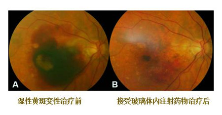 玻璃體視網膜,希瑪瑞視眼科,上海眼科醫(yī)院