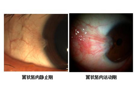 眼表眼角膜,希瑪瑞視眼科,上海眼科醫院 眼表眼角膜,希瑪瑞視眼科,上海眼科醫院