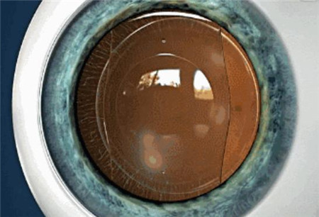 屈光矯視,希瑪瑞視眼科,上海眼科醫院 屈光矯視,希瑪瑞視眼科,上海眼科醫院