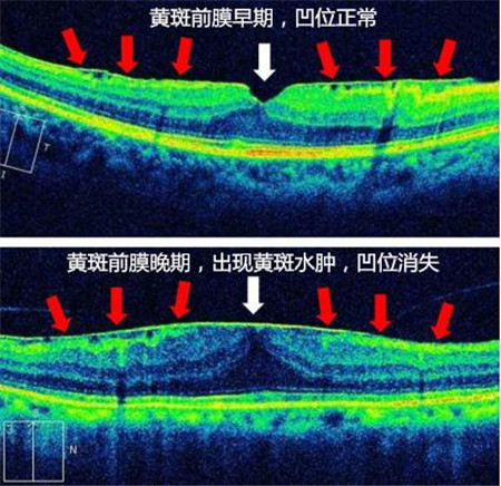 玻璃體視網膜,希瑪瑞視眼科,上海眼科醫(yī)院
