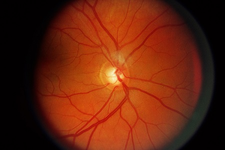 青光眼,?，斎鹨曆劭?上海眼科醫院