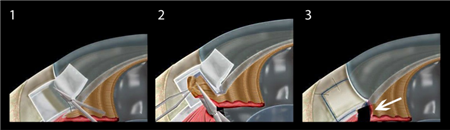 青光眼,?，斎鹨曆劭?上海眼科醫院