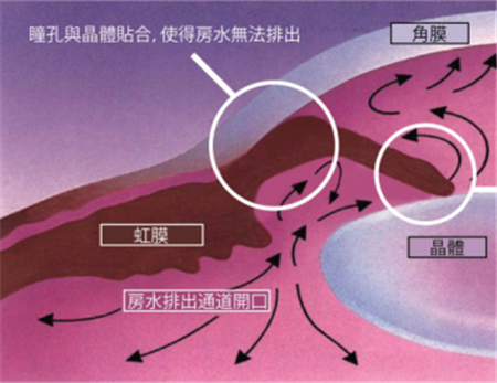 青光眼,?，斎鹨曆劭?上海眼科醫院