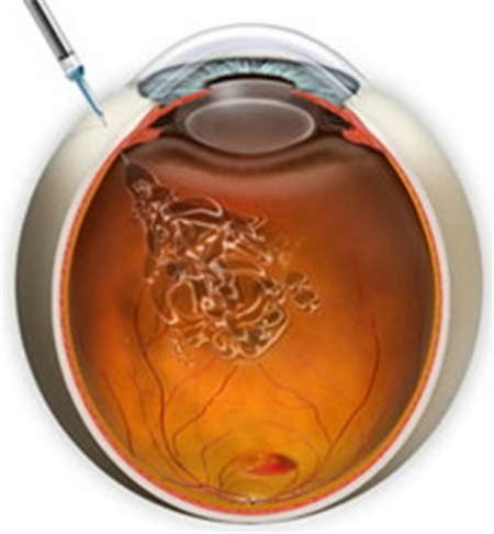 玻璃體視網膜,希瑪瑞視眼科,上海眼科醫院