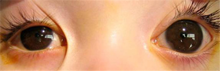 青光眼,?，斎鹨曆劭?上海眼科醫院