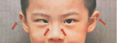 小兒眼病,希瑪瑞視眼科,上海眼科醫(yī)院