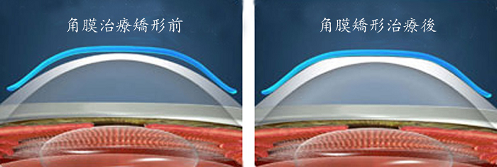 小兒眼病,希瑪瑞視眼科,上海眼科醫院