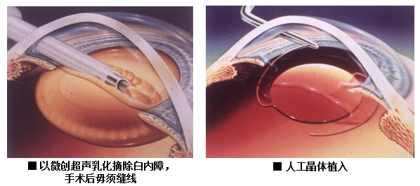 白內障,希瑪瑞視眼科,上海眼科醫院 白內障,希瑪瑞視眼科,上海眼科醫院