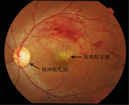 玻璃體視網膜,希瑪瑞視眼科,上海眼科醫院
