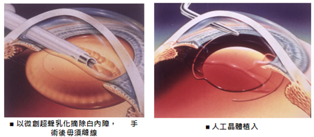 白內障,?，斎鹨曆劭?上海眼科醫院
