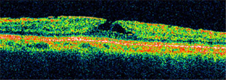 玻璃體視網(wǎng)膜,希瑪瑞視眼科,上海眼科醫(yī)院 玻璃體視網(wǎng)膜,希瑪瑞視眼科,上海眼科醫(yī)院