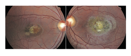小兒眼病,希瑪瑞視眼科,上海眼科醫院 小兒眼病,希瑪瑞視眼科,上海眼科醫院