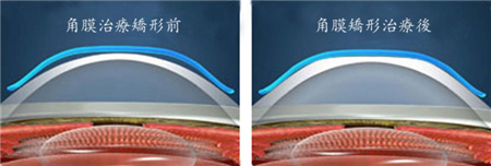 屈光矯視,希瑪瑞視眼科,上海眼科醫院