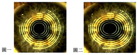 小兒眼病,希瑪瑞視眼科,上海眼科醫院