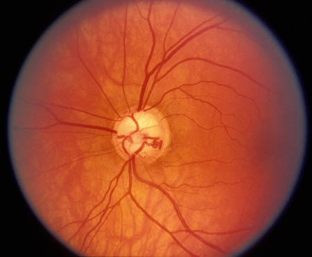 青光眼,?，斎鹨曆劭?上海眼科醫(yī)院