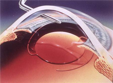 白內障,希瑪瑞視眼科,上海眼科醫院