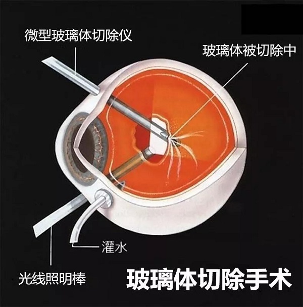 玻璃體視網膜,希瑪瑞視眼科,上海眼科醫院 玻璃體視網膜,希瑪瑞視眼科,上海眼科醫院