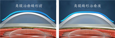 白內障,希瑪瑞視眼科,上海眼科醫院